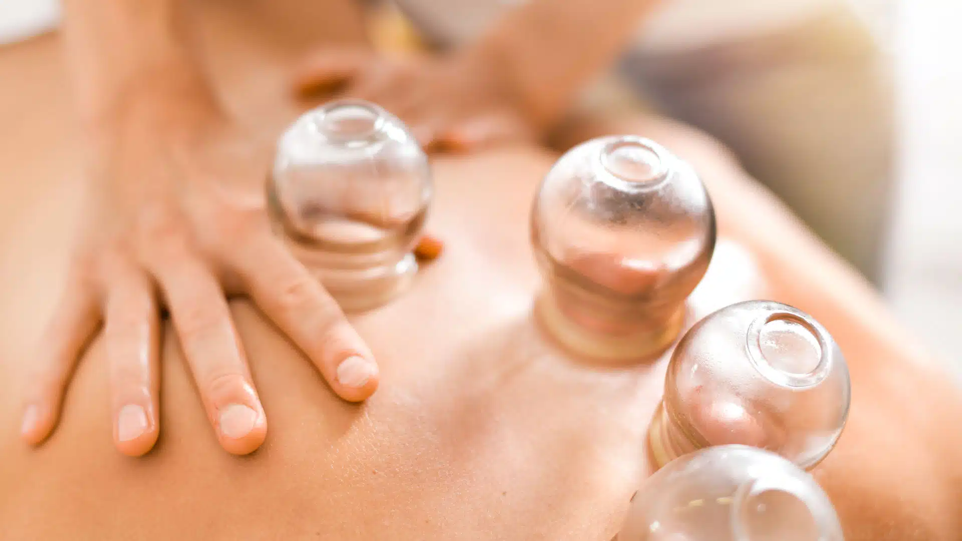 Yeppoon Naturopathic Oriental Cupping